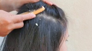 Dandruff Scratching, Itchy Dry Scalp, Huge Flakes, Psoriasis Treatment and Remove #534