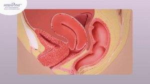 НоваРинг - механизм действия