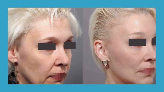 Dott. Carlo Pellegrini. Interventi di Lifting e Mini Lifting смотреть онлайн