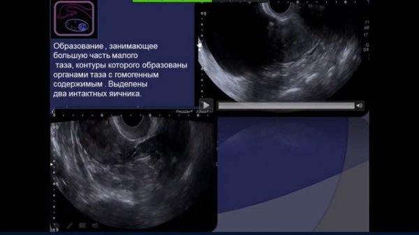 Исаева П. А. O-RADS