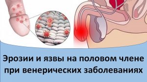 Эрозии и язвы на половом члене при венерических заболеваниях