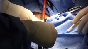 Radical Orchiectomy for Testicular Cancer