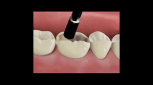 Пломбирование зуба.