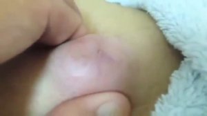 🔥 Выдавливание прыщей | Удаление и выдавливание прыщей и черных точек 2021 | Прыщи выдавливание #01