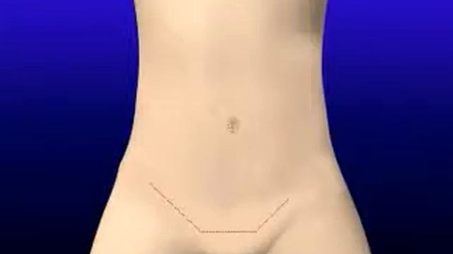 Dr. Fausto Bermeo - Interplástica FB - Abdominoplastia смотреть онлайн