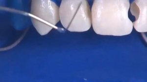 Реставрация центрального зуба (резец)