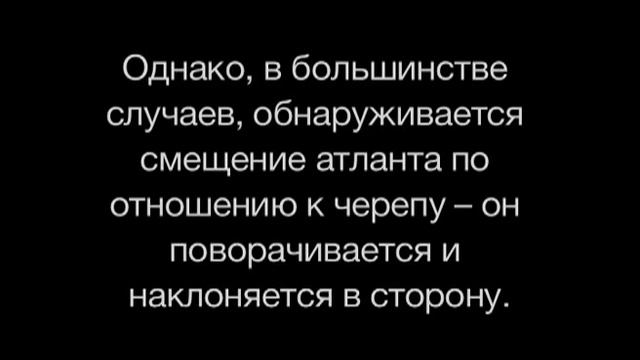 Atlasprofulax - процедура устранения смещения первого шейного позвонка смотреть онлайн