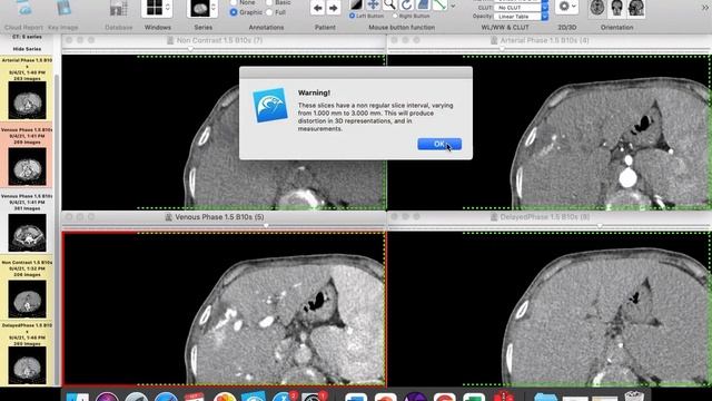 | GIT | Tumors | 2 | Hemangioma in cirrhotic liver | смотреть онлайн