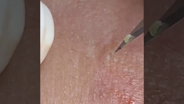 Relaxing Spa Очищение кожи Удаление прыщей #relaxing #spa смотреть онлайн