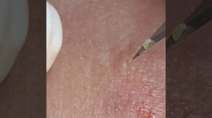 Relaxing Spa Очищение кожи Удаление прыщей #relaxing #spa