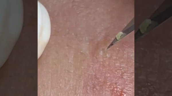 Relaxing Spa Очищение кожи Удаление прыщей #relaxing #spa