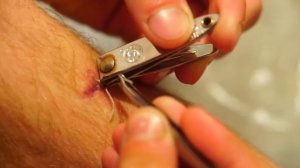 Самостоятельное снятие хирургического шва