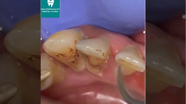 SCALING/CLEANING OF TEETH