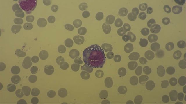 The pictures imprints of lymph node and bone marrow punctate. смотреть онлайн