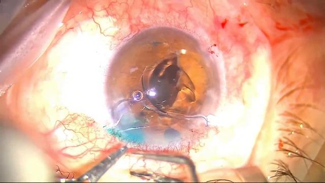 Замена помутневшей ИОЛ со склерокорнеальной фиксацией смотреть онлайн