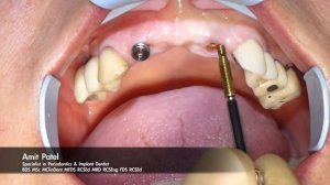 Exploring the NeoBiotech Implant Removal Kit with Dr Amit Patel