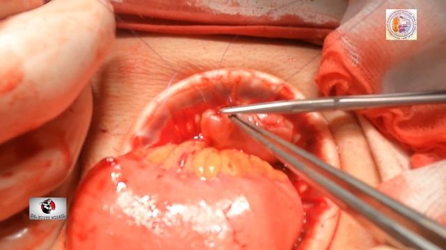 Small Bowel Resection - Side to Side Extracorporial Anastomosis/Резекция Тонкой Кишки смотреть онлайн