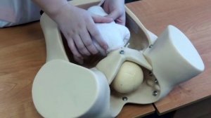 Биомеханизм родов при переднем виде затылочного предлежания