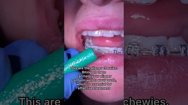 Getting your initial set of clear aligners / hybrid orthodontic / Tooth Time Family Dentistry NBTX смотреть онлайн