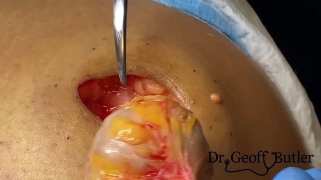Large cyst removal from hip смотреть онлайн