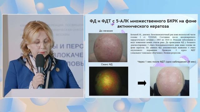 Флуоресцентная диагностика и фотодинамическая терапия больных раком кожи головы и шеи -Филоненко Е смотреть онлайн