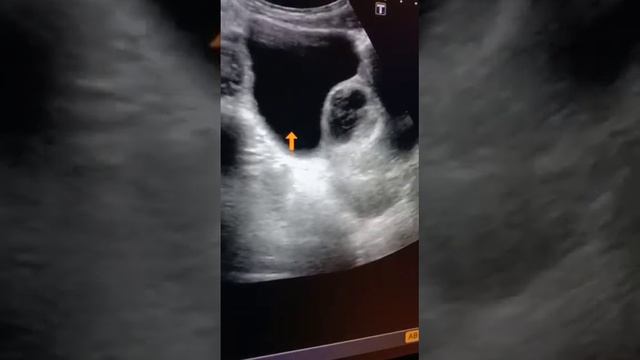 A Complex Right Ovarian Cyst Both Simple And Hemorrhagic