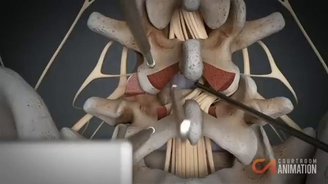 Removing Herniated Disk (Surgery Animation) смотреть онлайн