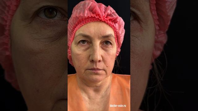 Через год после пластики верхних и нижних век  #блефаропластика