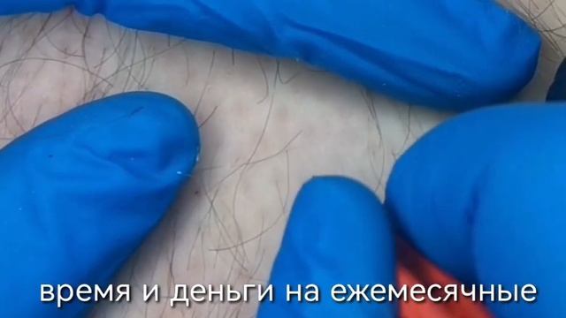 процесс электроэпиляции в телогене смотреть онлайн