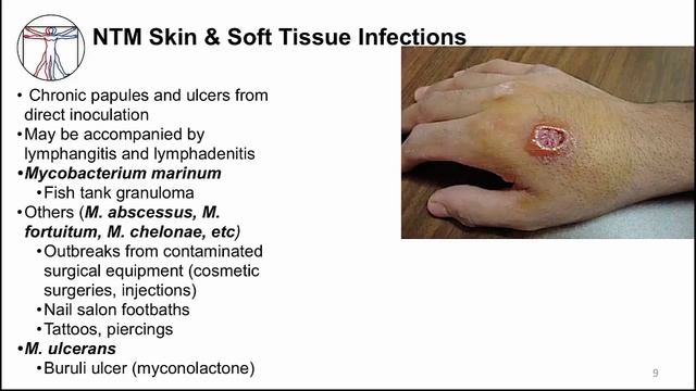 Tuberculosis: Other Mycobacteria смотреть онлайн