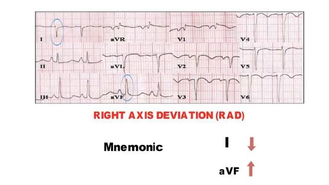 HOW TO READ AN ECG!! WITH ANIMATIONS(in 10 mins)!! смотреть онлайн