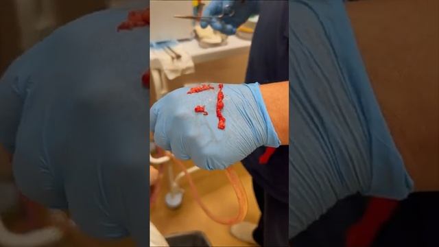 Удаление липомы без разрезов и швов смотреть онлайн