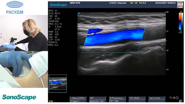 Мастер-класс на аппарате SonoScape S8Exp. Лектор: Балахонова Т.В. смотреть онлайн