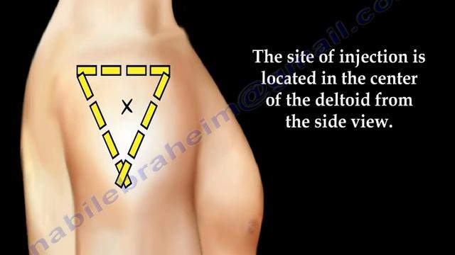 Deltoid Intramuscular Injection - Everything You Need To Know - Dr. Nabil Ebraheim