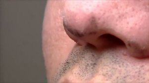 Удаление черных точек с носа с помощью полосок