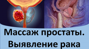 Массаж простаты. Выявление рака.