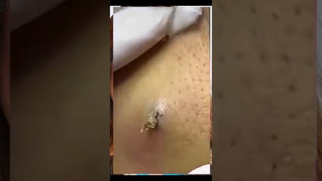 PIMPLE POPPING 2