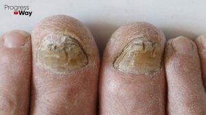 Ванночка с уксусом через 3 дня вытянула из организма такое! Просто опускаешь ноги и …