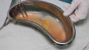 Пути заражения эхинококкозом.