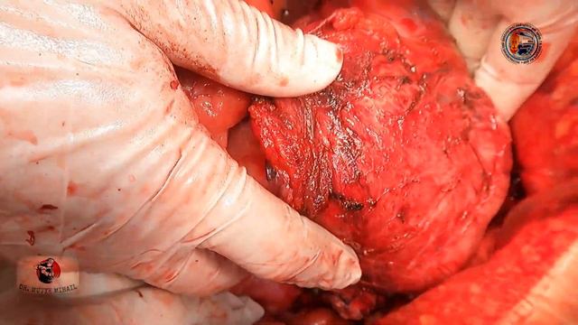 Open Extended Low Anterior Resection, Liposarcoma/расширенная  передняя резекция прямой кишки липоS