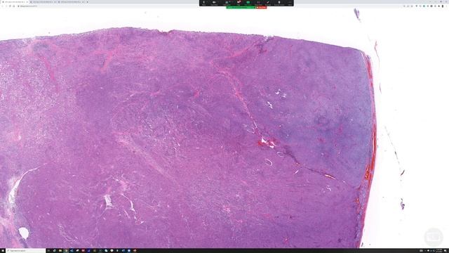 Rhabdoid Melanoma (Metastatic to Lymph Node) pathology dermatopathology dermatology dermpath смотреть онлайн