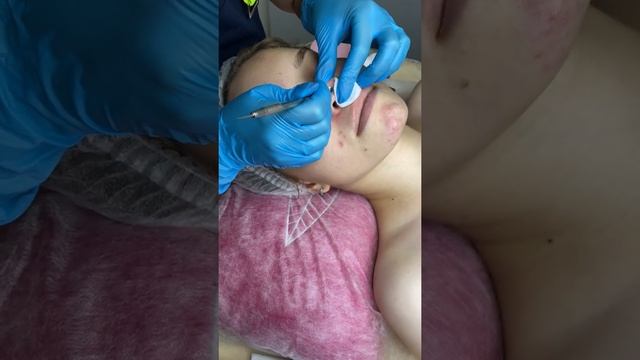 Комбинированная чистка лица смотреть онлайн