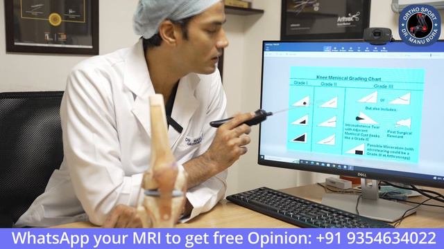 Knee Meniscus इंजरी में #Grading का क्या महत्व है, #meniscus #knee Injury Grade 1, 2, 3, Complex смотреть онлайн