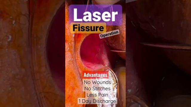 LASER FISSURE Operation kaise hota hai ? Fisher kya hai ? Fissure in Ano Treatment in India смотреть онлайн