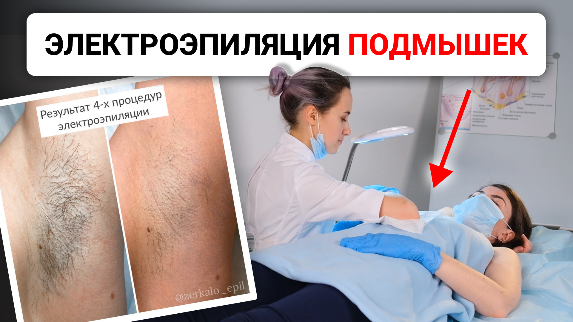 Урок №47. Техника проведения электроэпиляции подмышек. Как правильно делать электроэпиляцию? смотреть онлайн