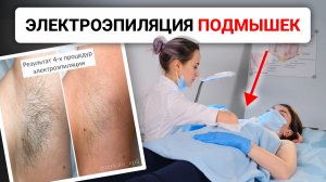 Урок №47. Техника проведения электроэпиляции подмышек. Как правильно делать электроэпиляцию?