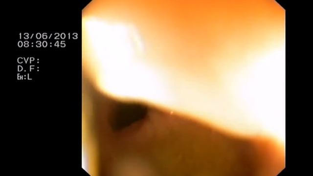 Параректальна нориця в ділянці анастомозу після резекції прямої кишки з приводу раку смотреть онлайн