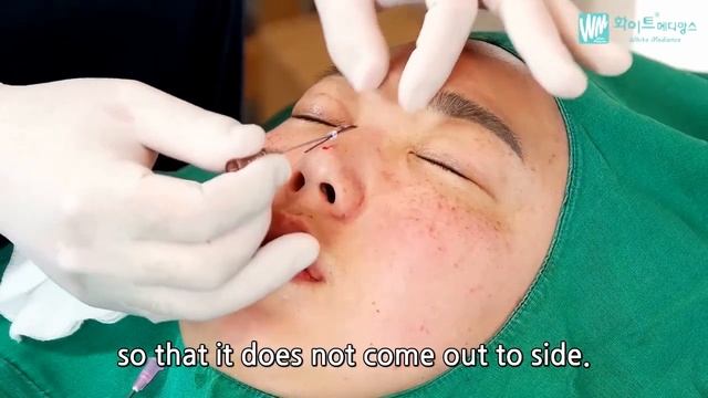 HIKO Thread Lifting - WhiteMedience