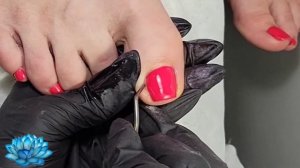 Как быстро удалить вросший ноготь на ноге.