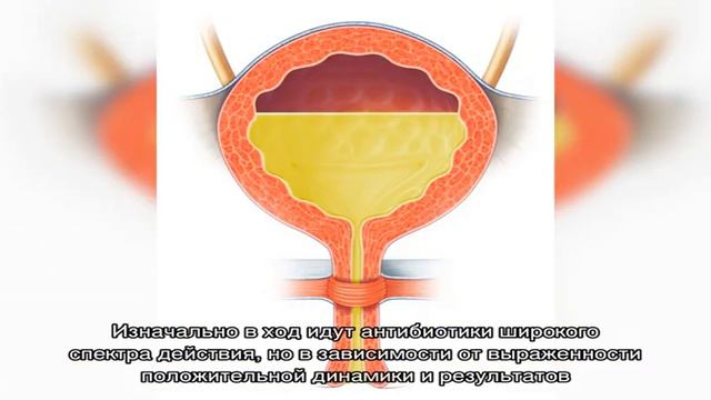 Что нужно делать при развитии цистита? смотреть онлайн